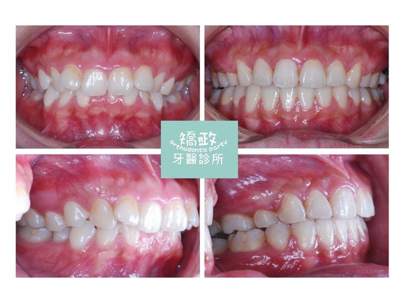 Case Five Protruding Teeth