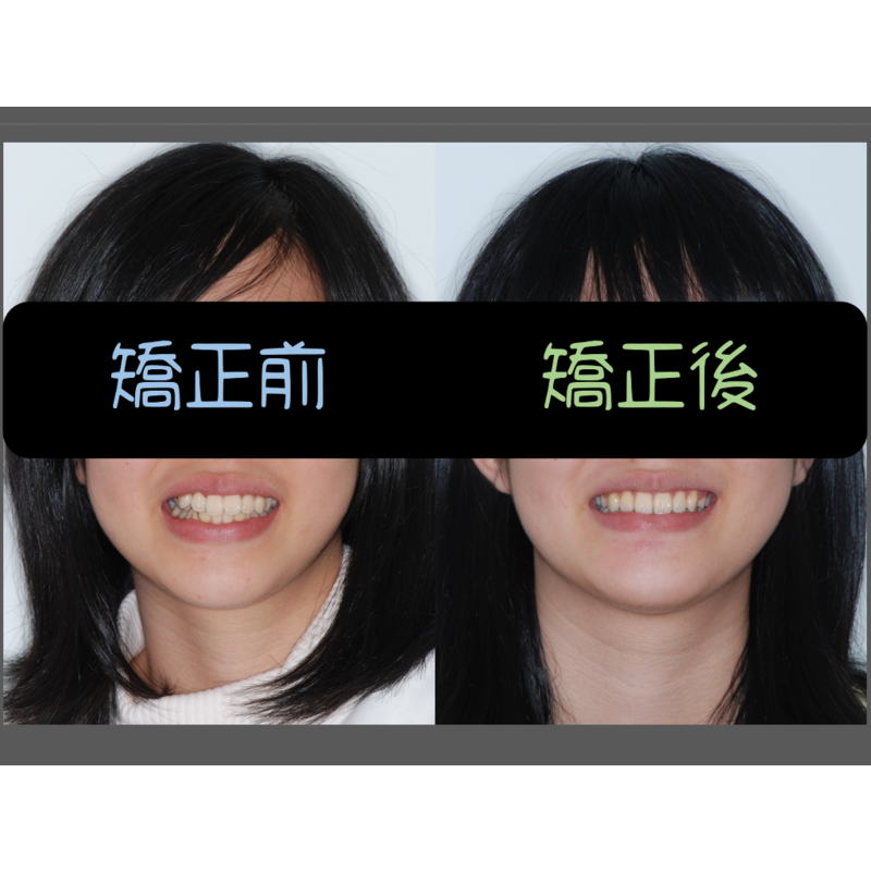 Case Four Crowded Teeth