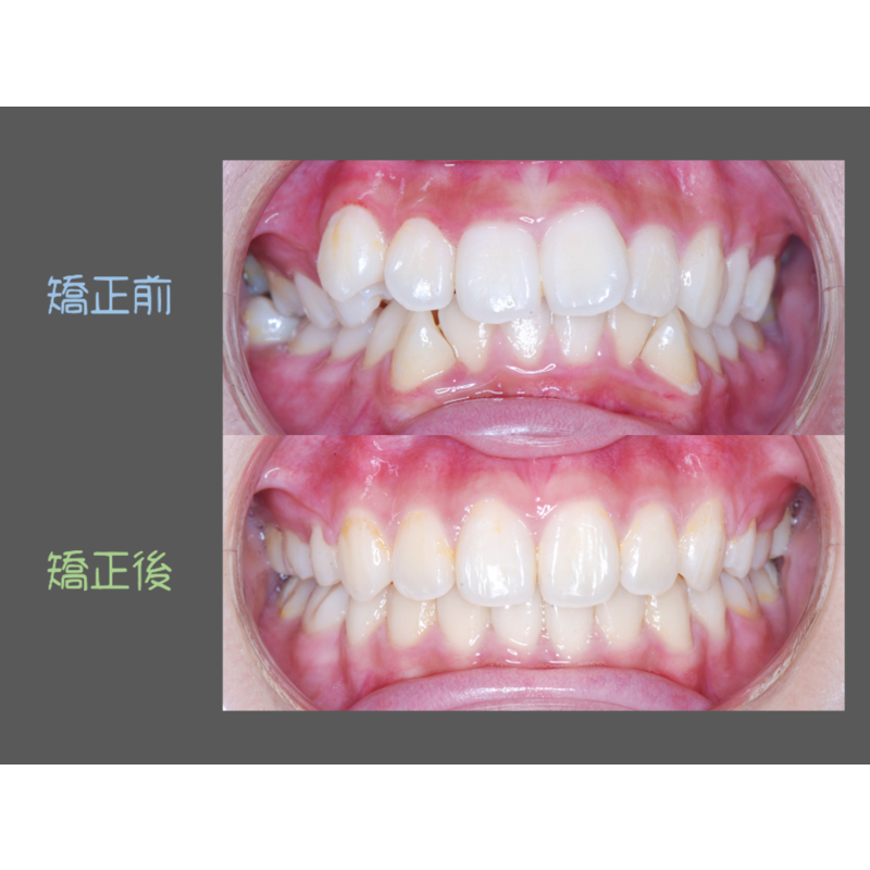 Case Four Crowded Teeth