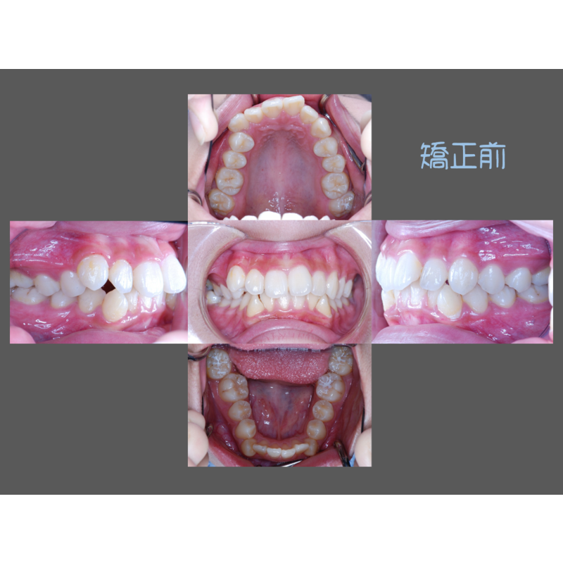 Case Four Crowded Teeth