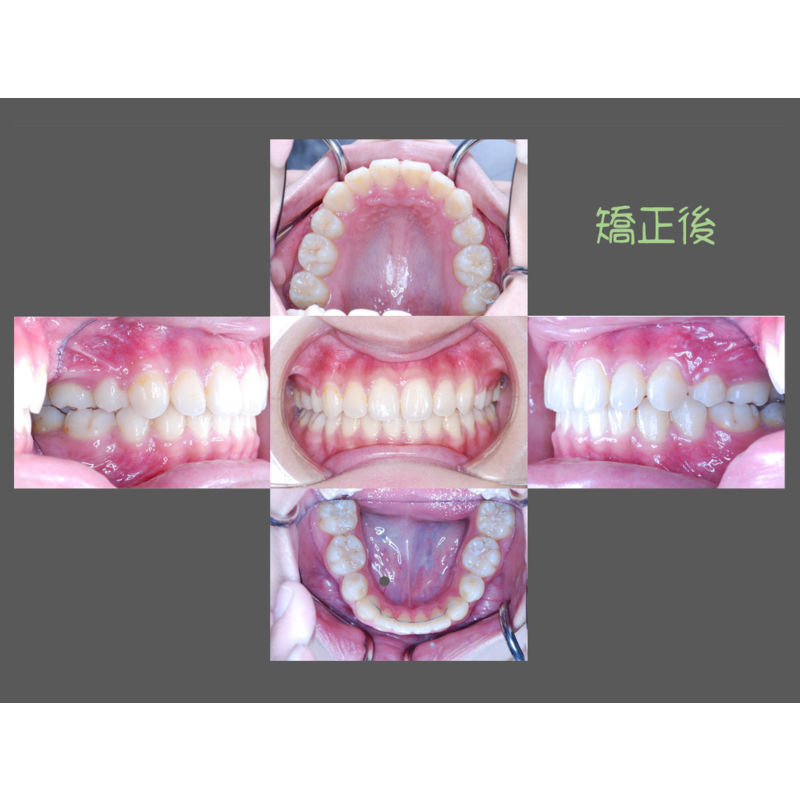 Case Four Crowded Teeth