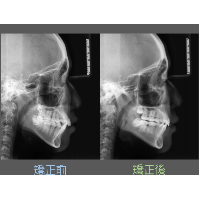 Case Four Crowded Teeth