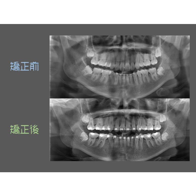 Case Four Crowded Teeth