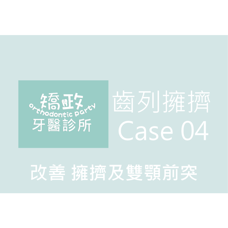 Case Four Crowded Teeth