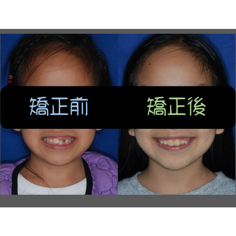 Case Four Invisalign