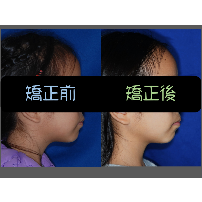 Case Four Invisalign