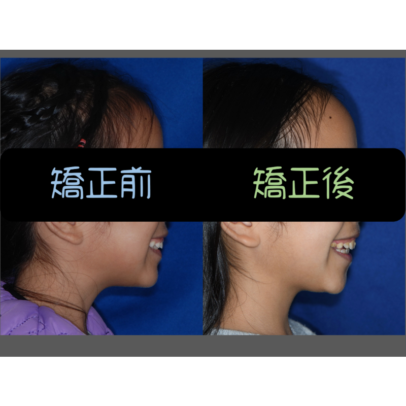 Case Four Invisalign