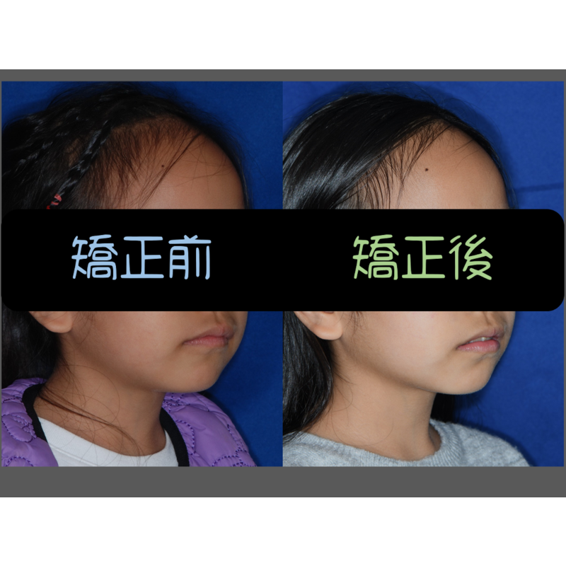 Case Four Invisalign