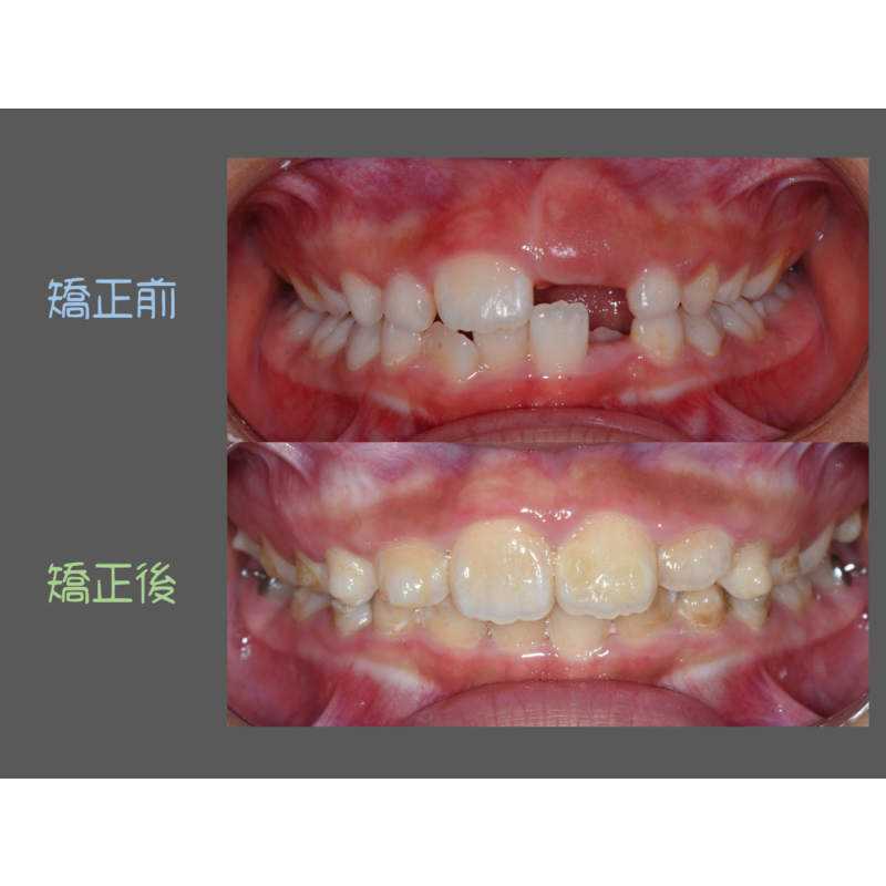 Case Four Invisalign