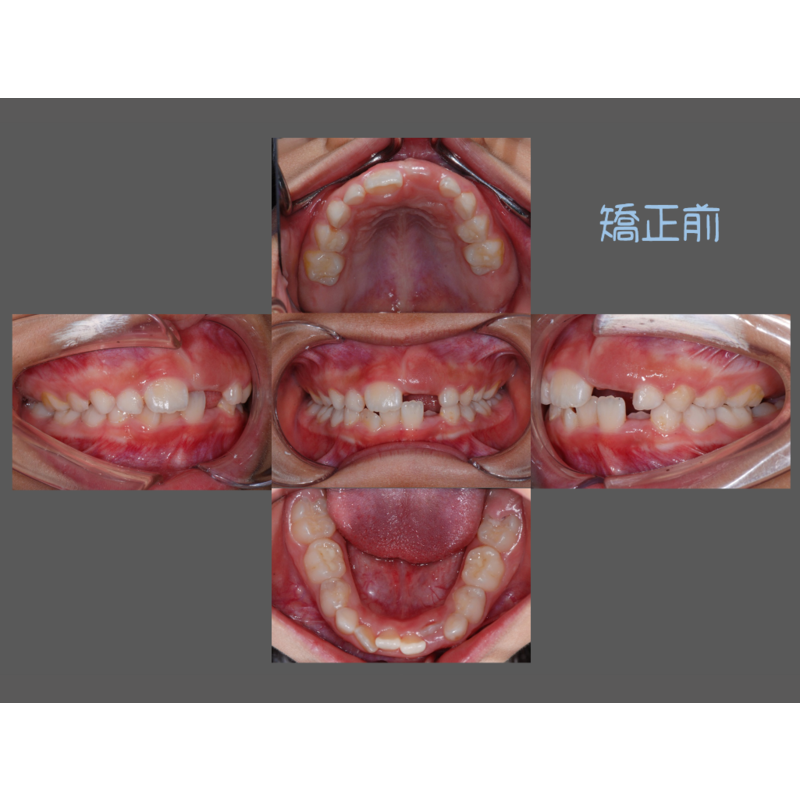 Case Four Invisalign