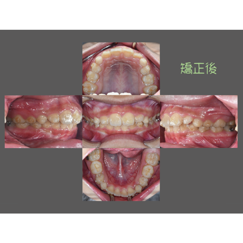 Case Four Invisalign