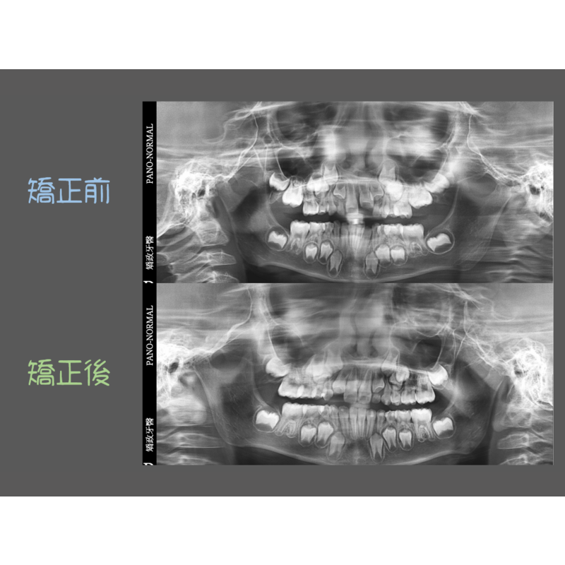 Case Four Invisalign