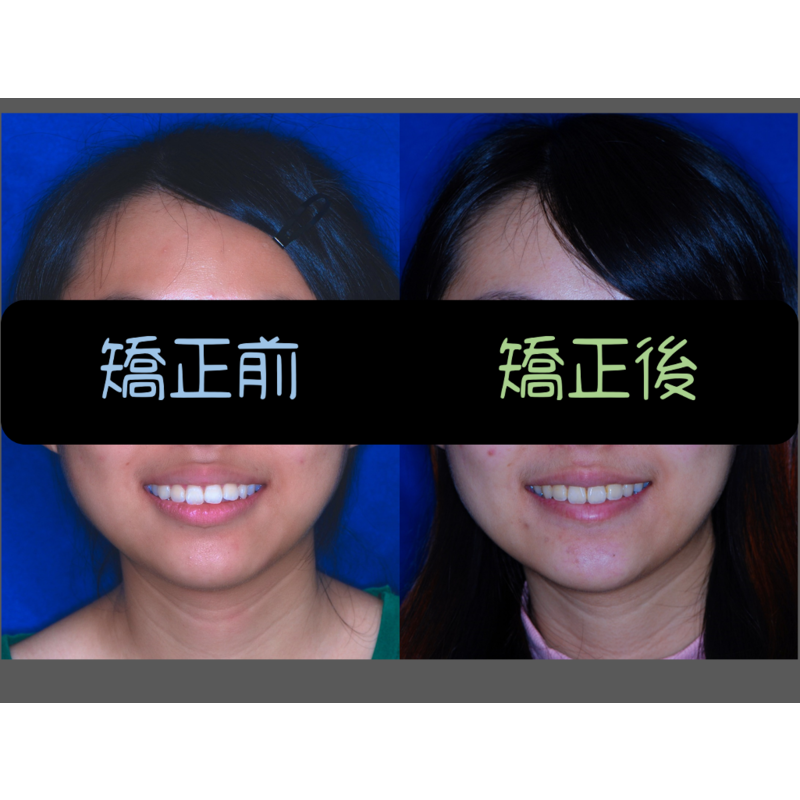 Case Four Protruding Teeth