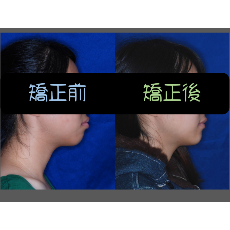 Case Four Protruding Teeth