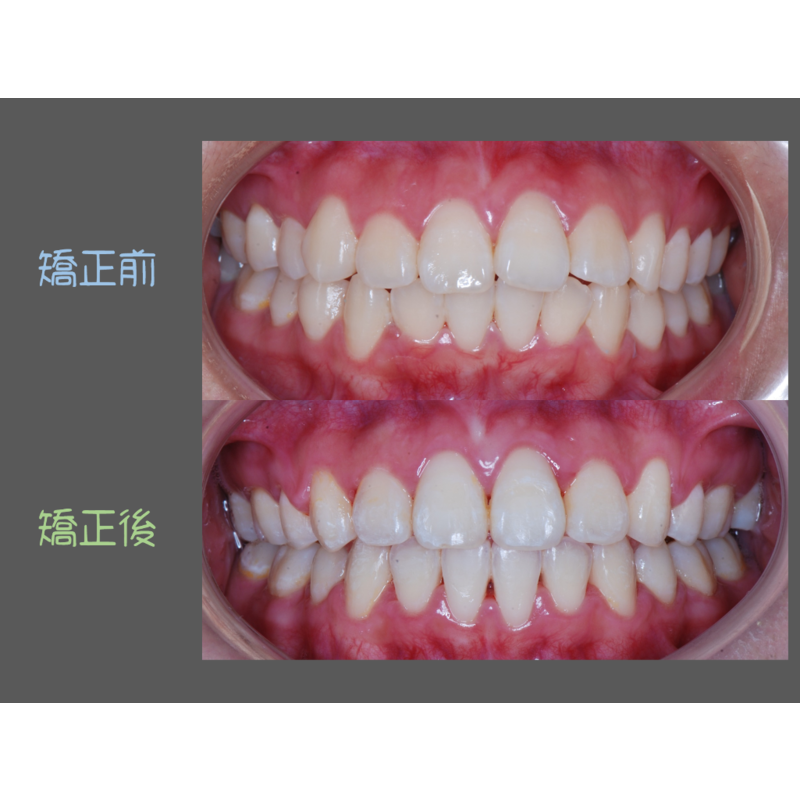 Case Four Protruding Teeth