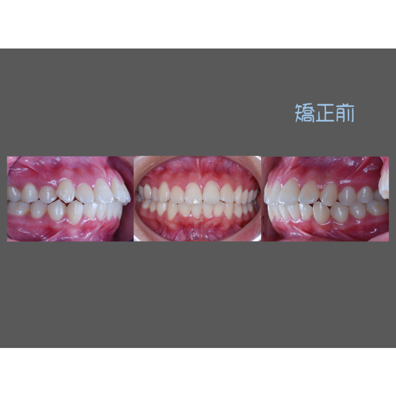 Case Four Protruding Teeth