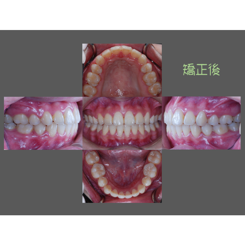 Case Four Protruding Teeth