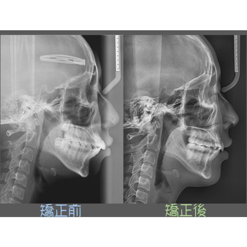 Case Four Protruding Teeth