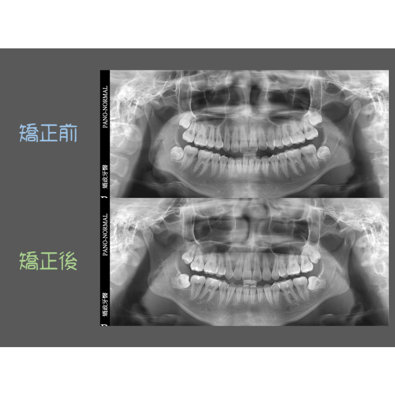 Case Four Protruding Teeth