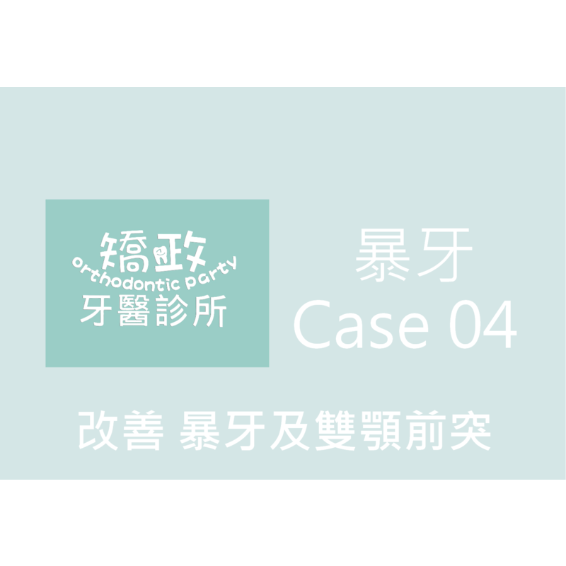 Case Four Protruding Teeth