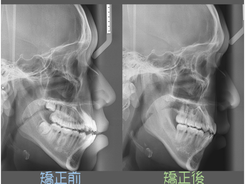 Case One Bite