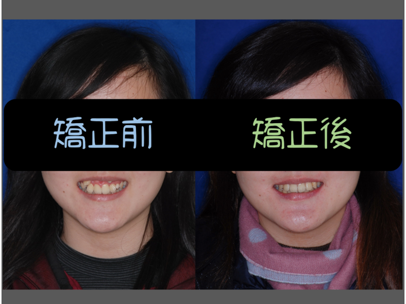 Case One Crowded Teeth