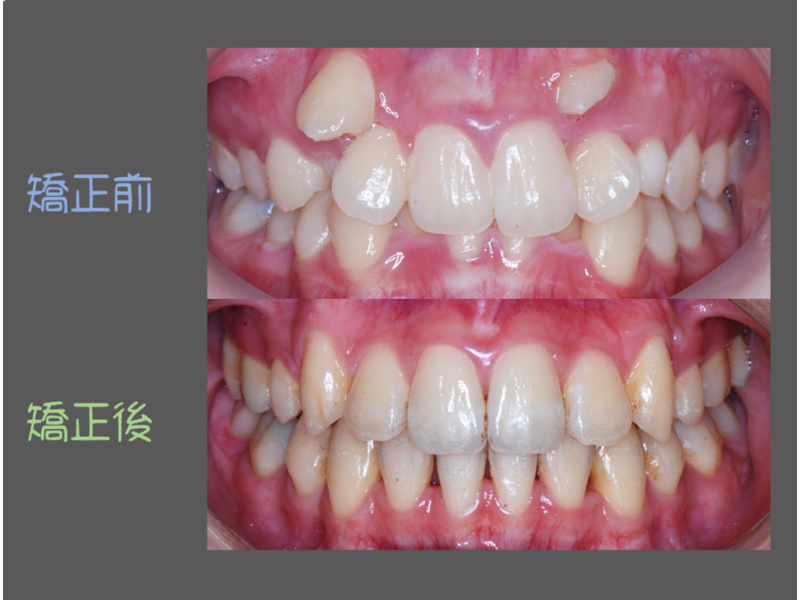 Case One Crowded Teeth