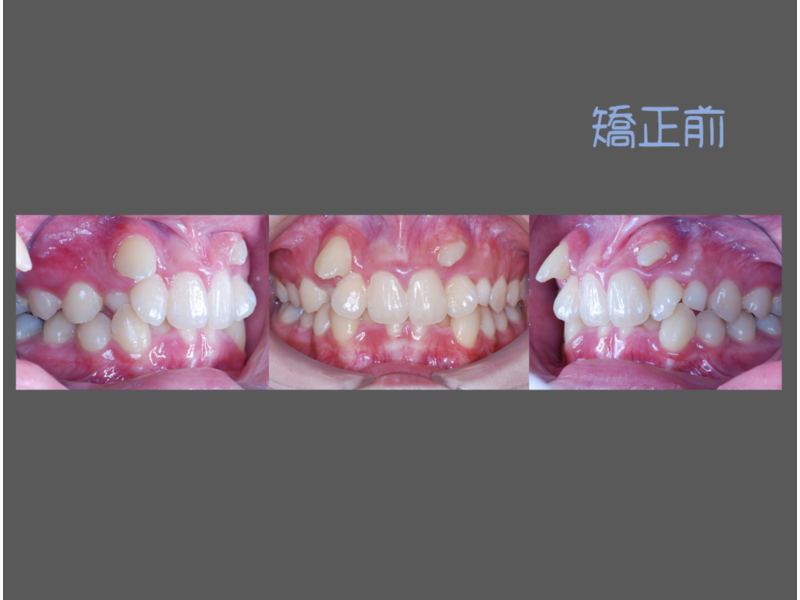 Case One Crowded Teeth