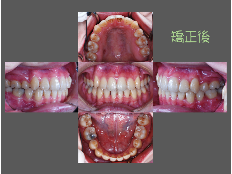 Case One Crowded Teeth