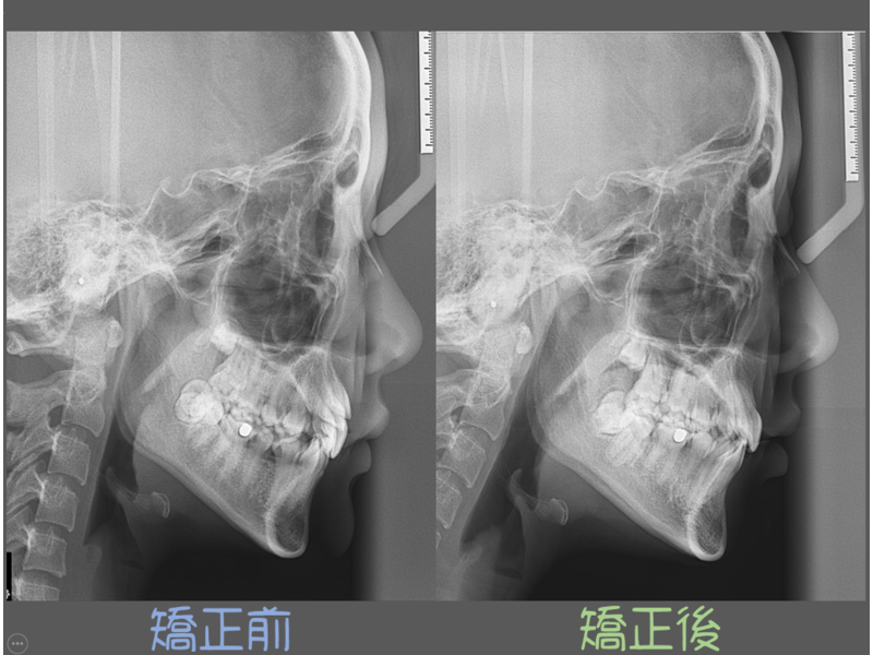 Case One Crowded Teeth