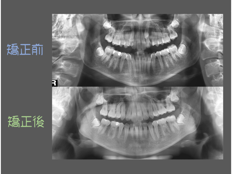 Case One Crowded Teeth
