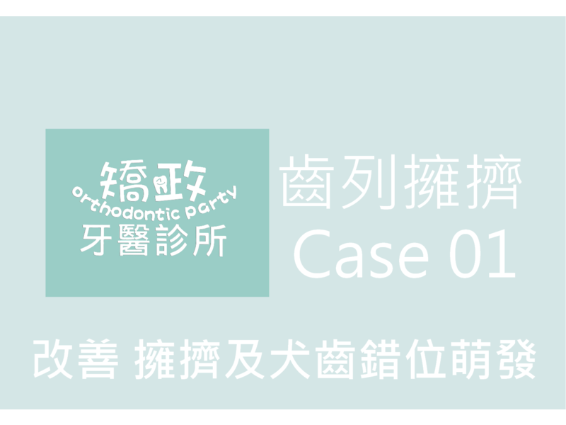 Case One Crowded Teeth