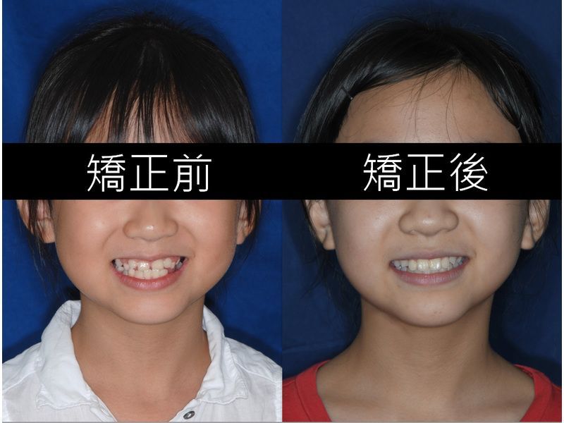 Case One Invisalign