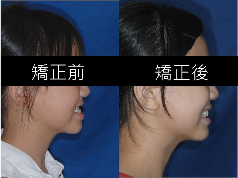 Case One Invisalign