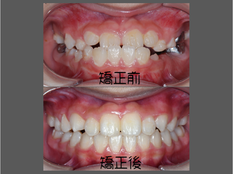 Case One Invisalign