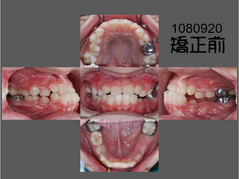 Case One Invisalign