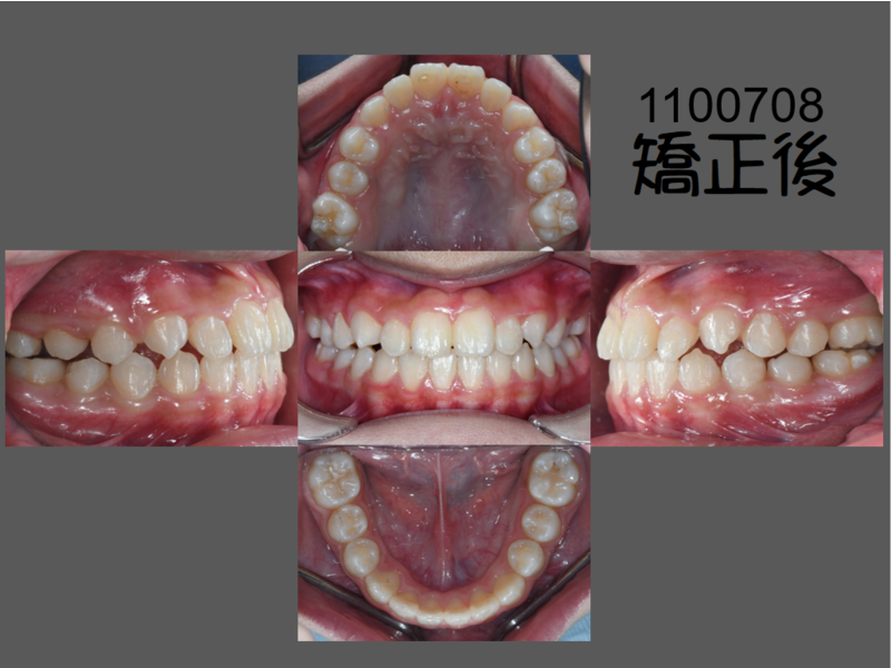 Case One Invisalign