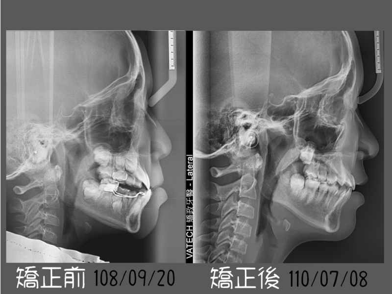 Case One Invisalign