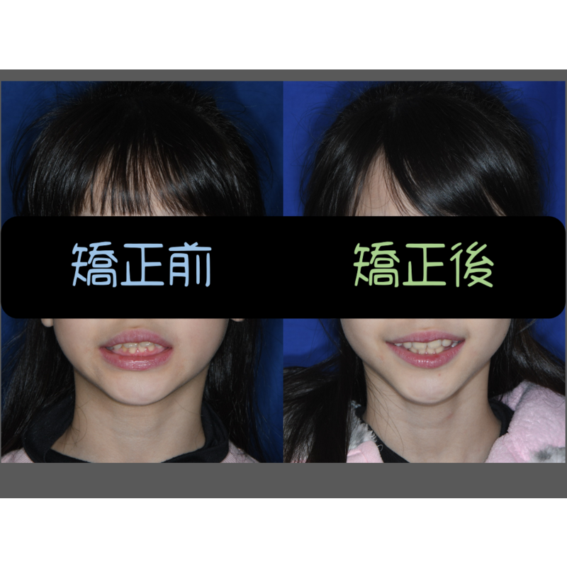 Case Seven Invisalign