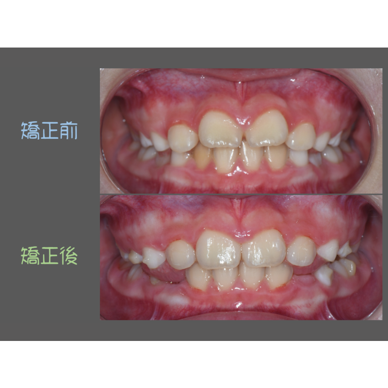 Case Seven Invisalign