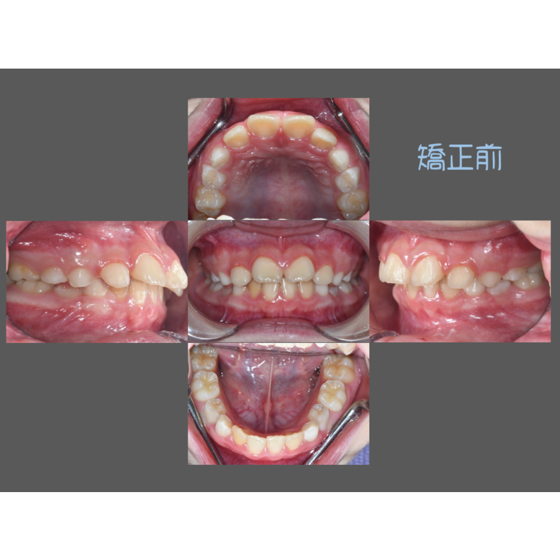 Case Seven Invisalign