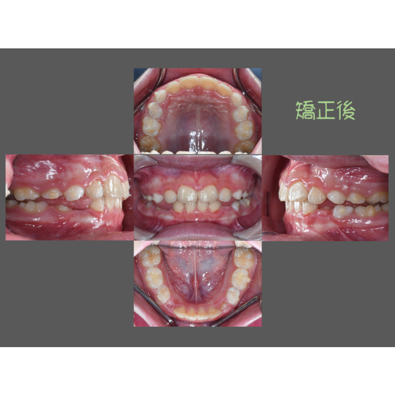 Case Seven Invisalign