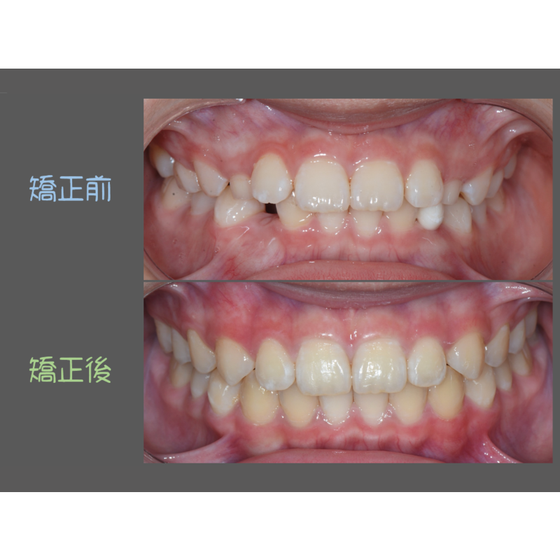 Case Six Invisalign