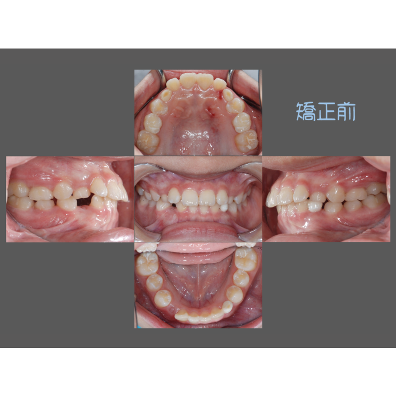 Case Six Invisalign