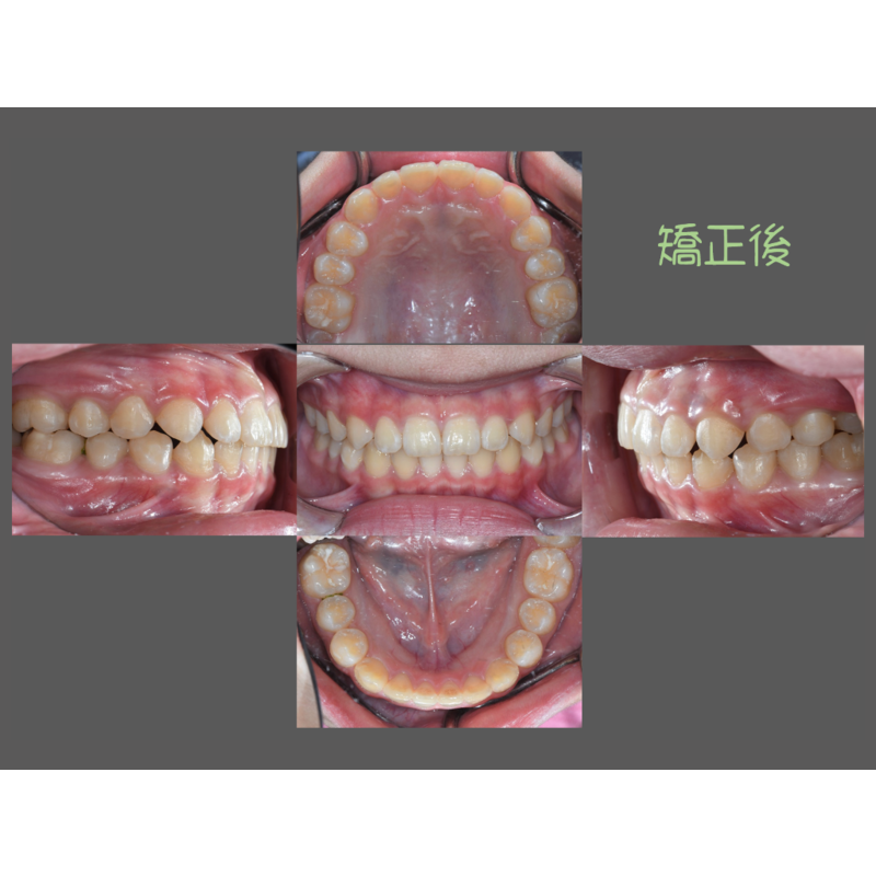 Case Six Invisalign