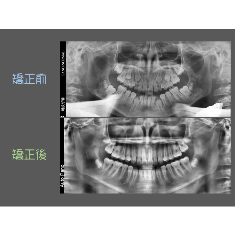 Case Six Invisalign