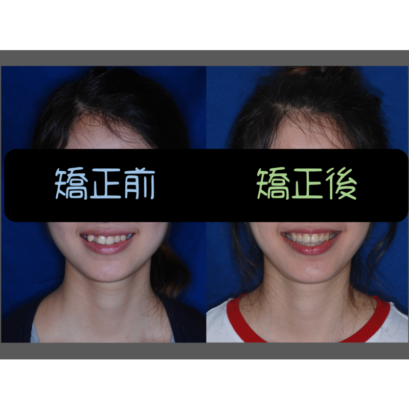 Case Three Crowded Teeth