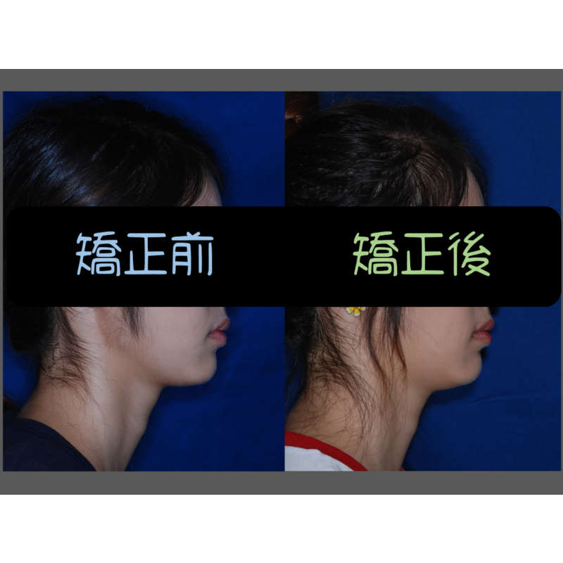 Case Three Crowded Teeth