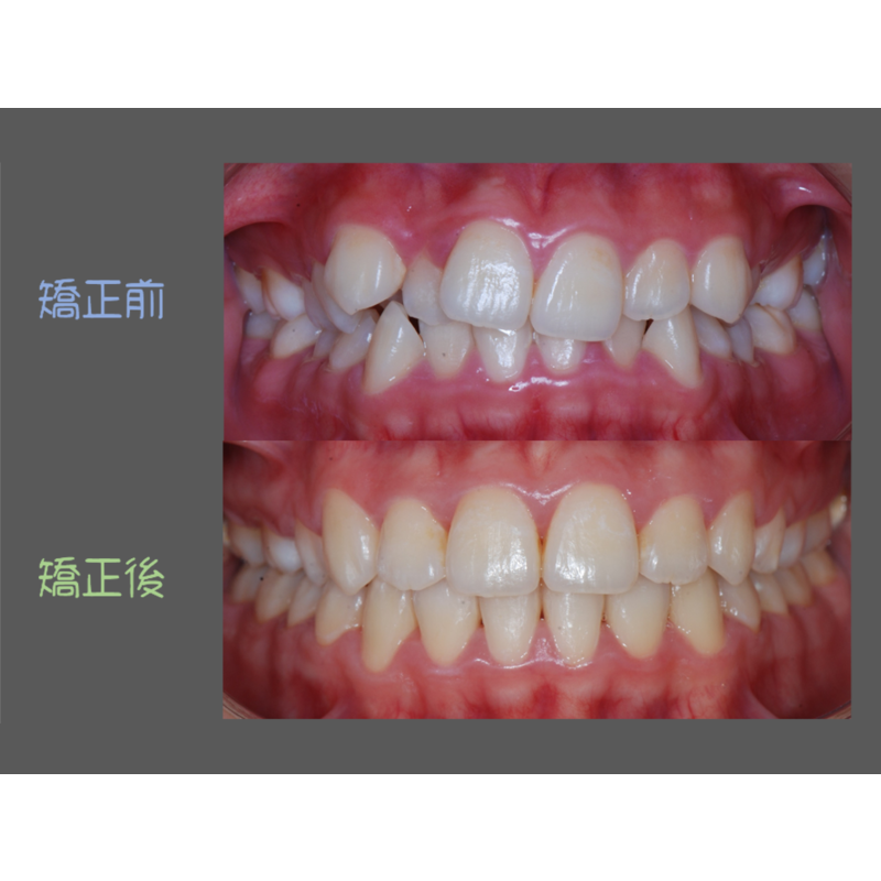 Case Three Crowded Teeth