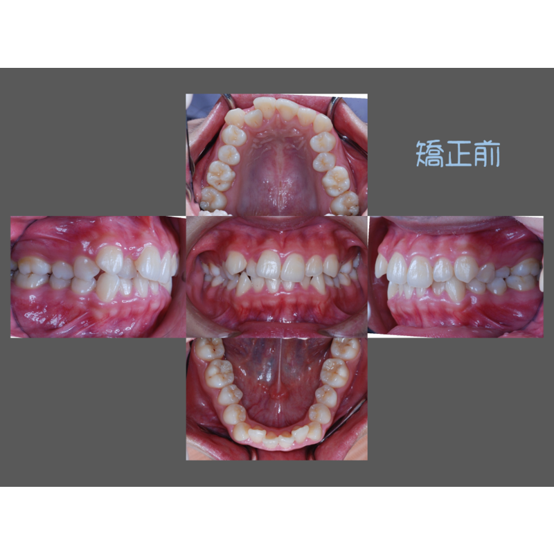 Case Three Crowded Teeth